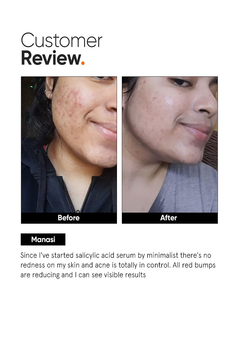 Salicylic Acid 2% Face Serum