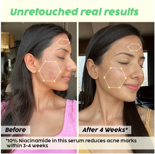 PLIX - Jamun 10% Niacinamide Face Serum for Blemishes & Acne Marks Removal - 30ml