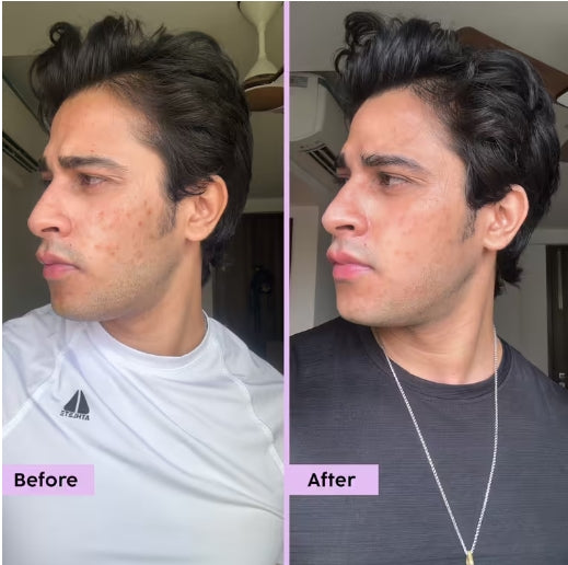 PLIX - Jamun 10% Niacinamide Face Serum for Blemishes & Acne Marks Removal - 30ml