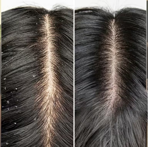 PLIX - Neem Anti-Dandruff Shampoo & Conditioner | Helps Reduce Dandruff & Soothe Itchy Scalp