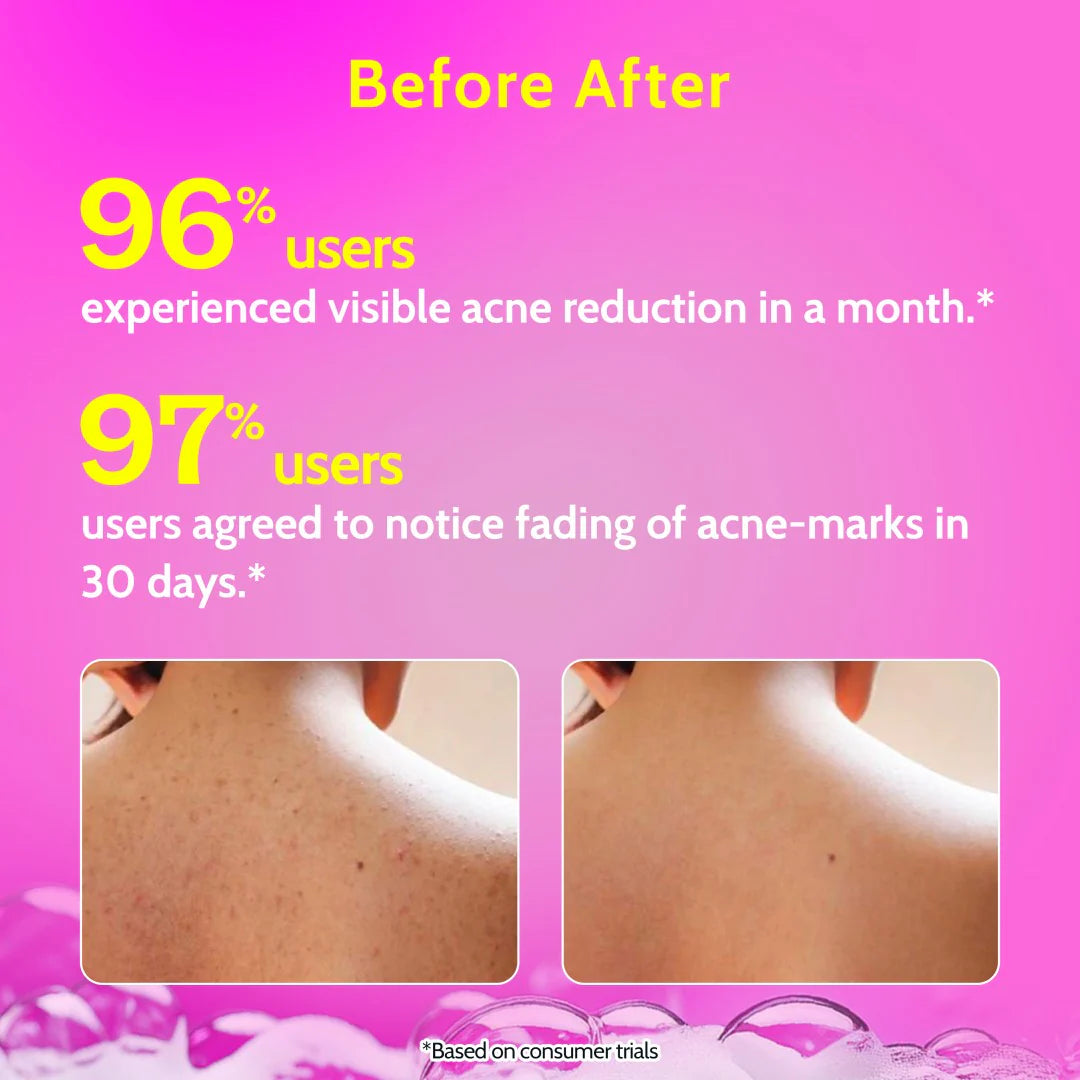 Chemist at Play - Salicylic Acid Body Wash for Acne Control - 236 ml